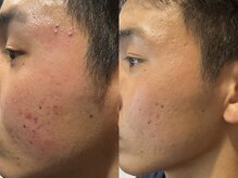 ヨハク(YOHAKU)/ニキビ肌改善！