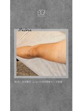 ゴーマルイチ(501)/メンズ脱毛　Before/After