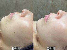 アンドミー 中百舌鳥(&me)/ララピール【艶肌/美白/くすみ】