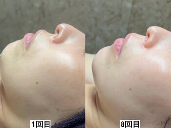 アンドミー 中百舌鳥(&me)/ララピール【艶肌/美白/くすみ】