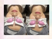 ベル(Belle+vi)/光フォトですっきり！