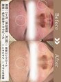 ファッショニスタ 恵比寿東口(Fashionista) 【メニュー:ララピール・ハイドロ/期間:2カ月/悩み:ニキビ】