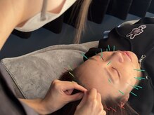 アロエベル(aloe Belle)/美容鍼