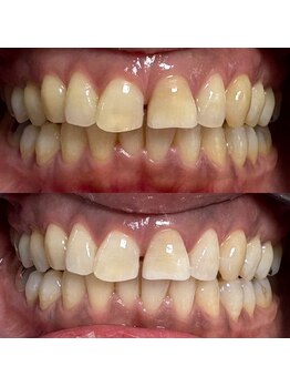 Grace Whitening Yokohama/40分照射＋水素吸引