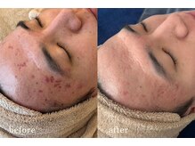 サロンムーン 赤坂(salon moon)/繰り返す肌トラブルを改善