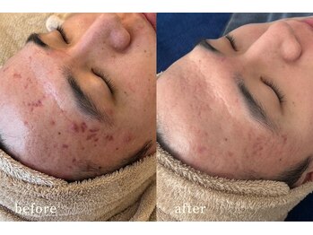 サロンムーン 赤坂(salon moon)/繰り返す肌トラブルを改善