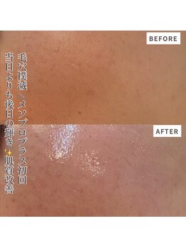 クラルテアンドコー(Salon Clarte&Co.)/毛穴撲滅#メソプロプラス初回