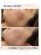 リヴェーヌ 呉羽店(Riverne)の写真/【人生最後の肌質改善へ】肌荒れ、乾燥、毛穴、くすみ！！贅沢に生コラーゲンを使用。肌結果へ導きます♪