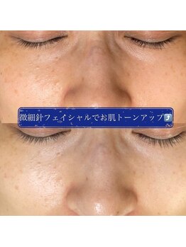 ヌーベルコピーヌ 五井店/微細針フェイシャルエステ大人気