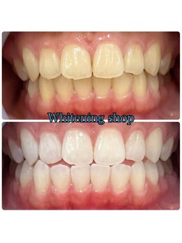 ホワイトニングショップ 和歌山店/Before&After美白ホワイトニング