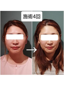 エルアンドエス(L&S)/本来の顔の輪郭へ！