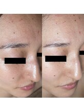 ネオオアシス トウキョウ(ネオOASIS TOKYO)/ハーブピーリング（剥離あり）