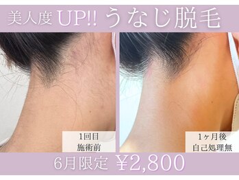 エム(eM.)/うなじ脱毛