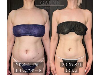 ガーネ 堺店(GARNE)/痩身ビフォーアフター/50代
