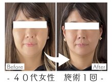 ほうれい線/目元・口元たるみ改善/小顔/二重アゴ/首肩こり/頭痛