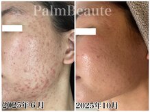 パームボーテ(Palm Beaute)/長年のお肌悩み　ニキビケア