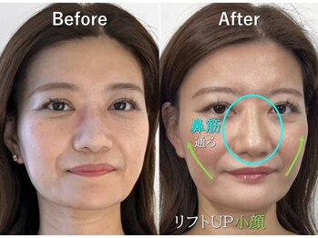 ラプリアンジュ 鹿児島天文館店(Raplit ange)/隆鼻+輪郭矯正40分10回