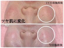 シルク(Cilk)/荒れたお肌がツヤ肌に！