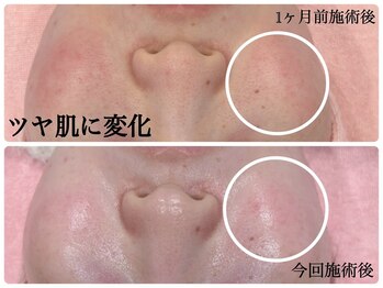 シルク(Cilk)/荒れたお肌がツヤ肌に！