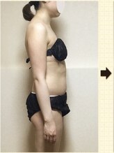 ノットノット 自由が丘(Not Knot)/１.ブライダル シンデレラ施術前