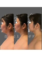 エミナル(EMINALu)/ストレートネック解消