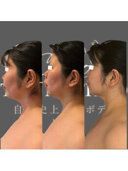 エミナル(EMINALu)/ストレートネック解消