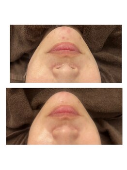 ヴィヴ コレビ(VIV COREBI)/一度で赤いポツポツが♪