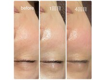 テルヒブール(terhibur)の雰囲気（ラミネーションピールで肌質改善うるツヤ肌に◎）