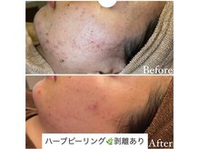 マドモアゼル 麻布十番/ハーブピーリング