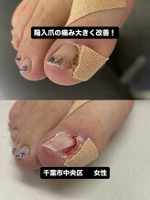 巻き爪じゅん 船橋店/巻き爪じゅん千葉駅前陥入爪施術