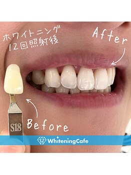 ホワイトニングカフェ 熊本店(WhiteningCafe)/◎歯のホワイトニング症例写真◎