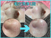 たった1回で？！鼻＋頬の黒ずみ開きリセット★専門店の毛穴洗浄