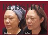 【最新輪郭形成施術】老け顔脂肪撃退☆たるみ脂肪改善〈REDSHOT〉2cc￥8,800