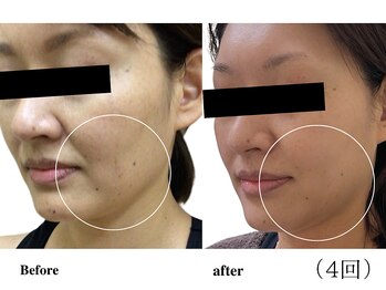 ウィズマツオカ 光の森店/エイジングエステ 症例写真