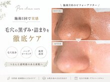 毛穴悩み専門サロン【three】 毛穴洗浄｜ハーブピーリング｜小顔矯正