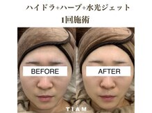 ティアム バイ テトテ 神戸三宮(TIAM by tetote)/毛穴洗浄＋ハーブ＋水光ジェット