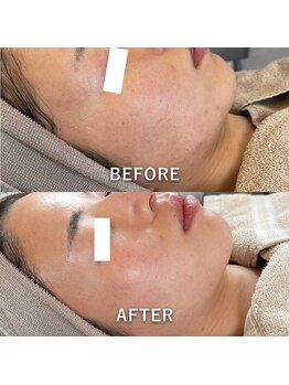 ミジョカフェイシャル(mijoka facial)/ニキビケア