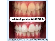 ホワイトニングサロン ホワイト(WHITE)/セルフホワイトニング/大阪/福島