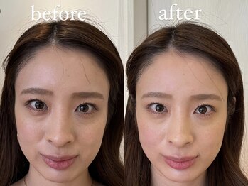 ハリノヒ 大阪院/美容鍼でくすみ・たるみ改善事例