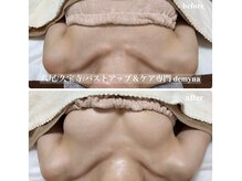 デミーナ(Demyna)/【バストアップ】症例 育乳