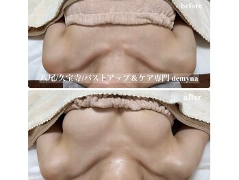 デミーナ(Demyna)/【バストアップ】症例 育乳