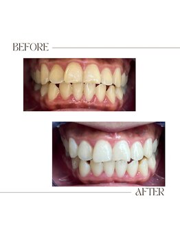 エクシアホワイトニング 郡山店/ホワイトニングビフォーアフター