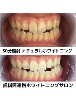 プラチナムビューティ 四条烏丸店(PLATINUM Beauty)/ホワイトニングビフォーアフター