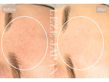 リリーブー 池袋(Lilyboo)/韓国肌管理 ICUピーリング