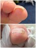 【爪の巻きによる痛みでお困りの方へ】巻爪ケア¥11000