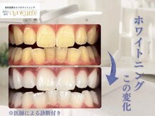 シアホワイト(CIA WHITE)/劇的ビフォーアフター