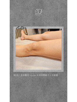 ゴーマルイチ(501)/メンズ脱毛 Before/After