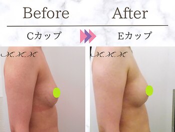メディカルサロン エム エム エム 心斎橋本店(M.M.M)/【バストアップ例】　C→Eカップ