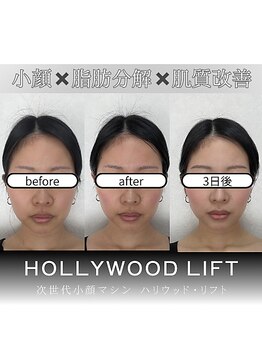 ブリリオプラス 広島並木店(Brillio Plus)/レモンボトル×プラズマシャワー