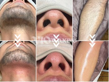 ヴィオワクシング(VIO WAXING)の写真/男性も安心の完全個室★気になるVIO（ブラジリアンワックス）や髭・ボディのムダ毛をスッキリ解消！